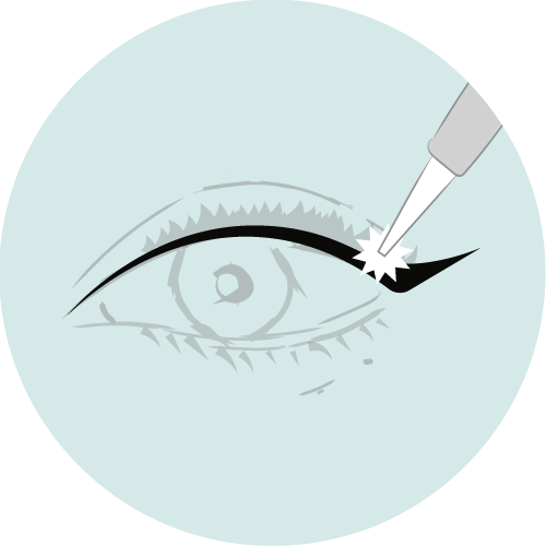 Pico Laser Removal Eyes