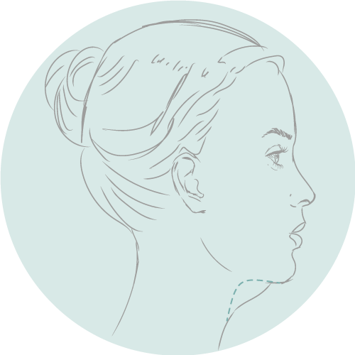 Sarasin Chubby Chin Package (1ste behandeling)