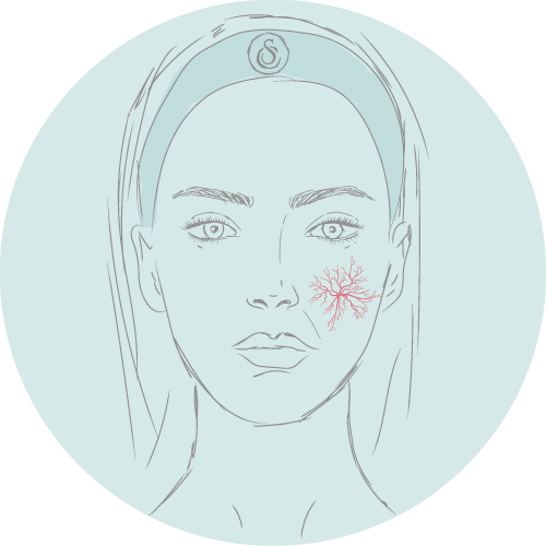 Spidervein Removal